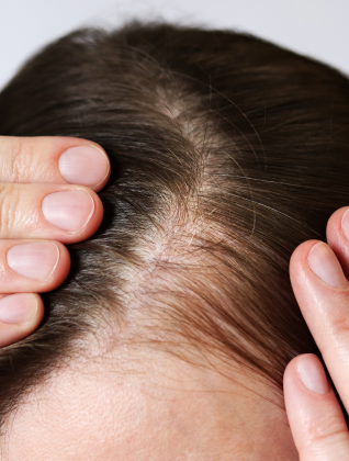Female hair loss
